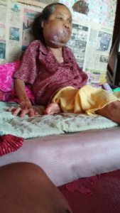 Ibu Rumlah Mengidap kanker bawah rahang/Foto Dok. Pribadi/Nusantaranews