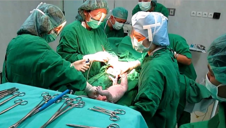 Operasi caesar (Foto via panduanpbjs)