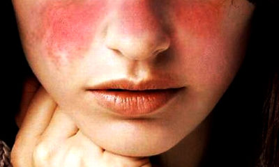 Penyakit Lupus Pada Perempuan. (Foto: Ilustrasi/Parahita Diagnostic Center)
