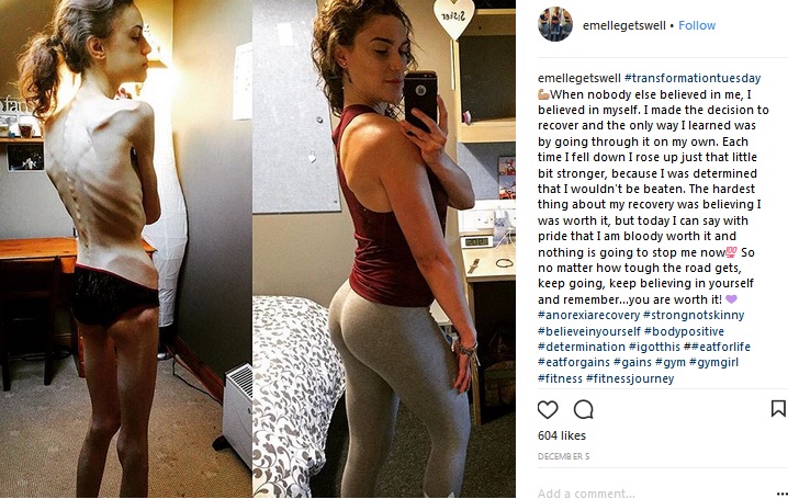 Emelle Lewis, gadis Huddersfield berusia 22 tahun mengidap anoreksia merasa terbantu oleh Instagram. Foto: Instagram/Emele Lewis