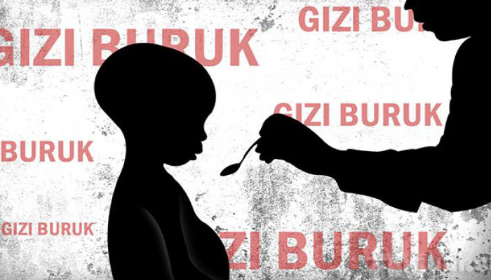 Gizi Buruk (Ilustrasi)