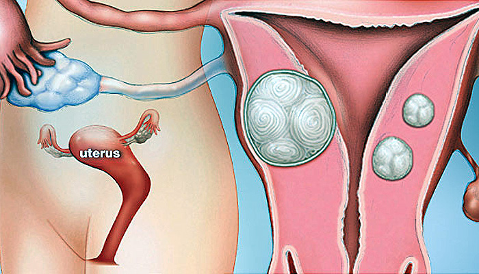 Mengenal Gejala Fibroid Rahim